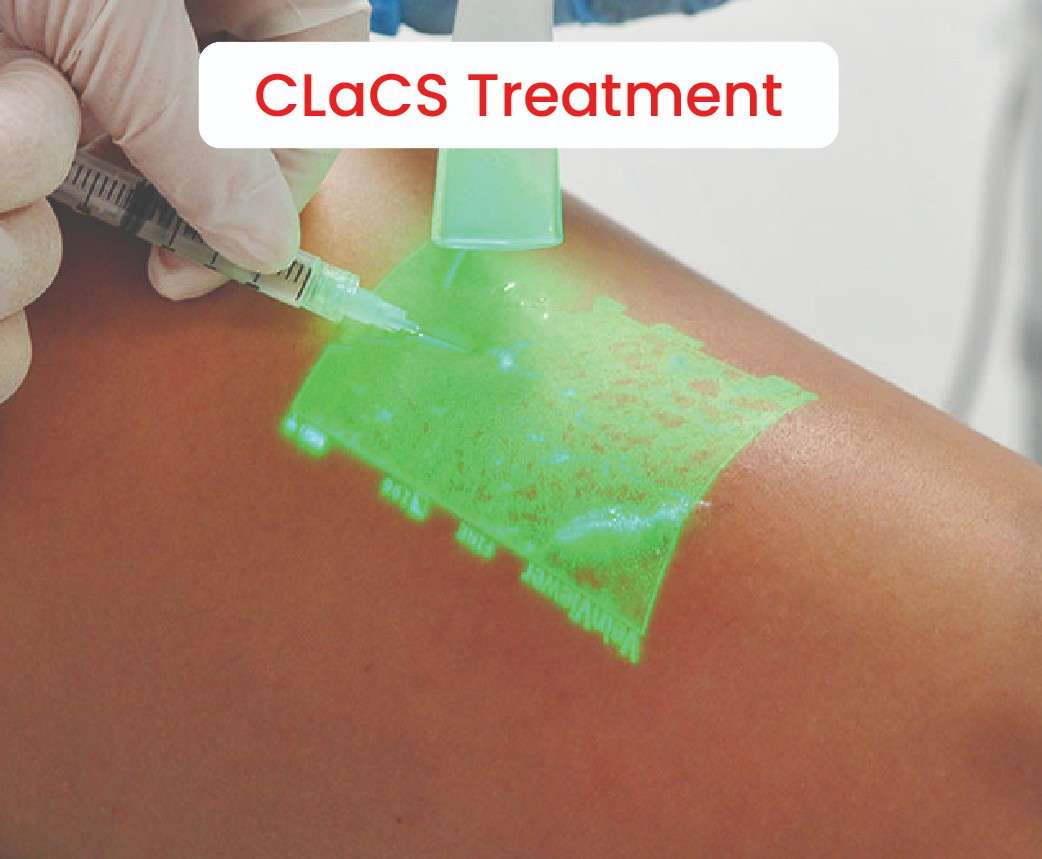 CLaCS Treatment