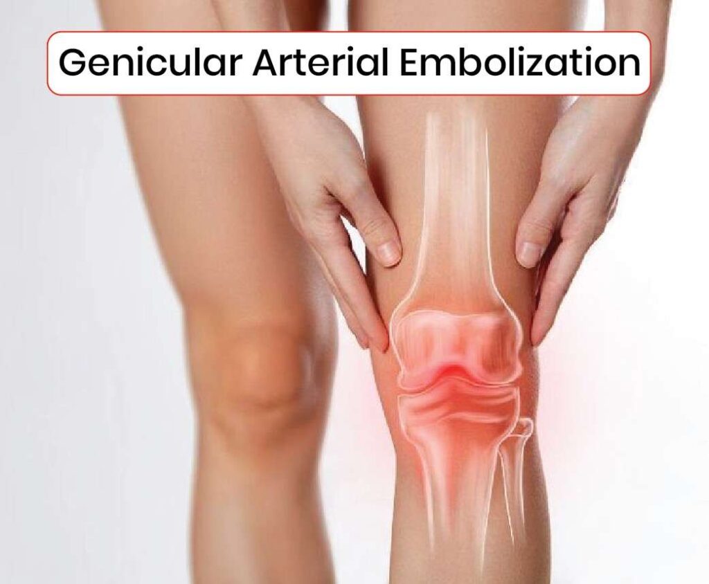 Genicular arterial embolization