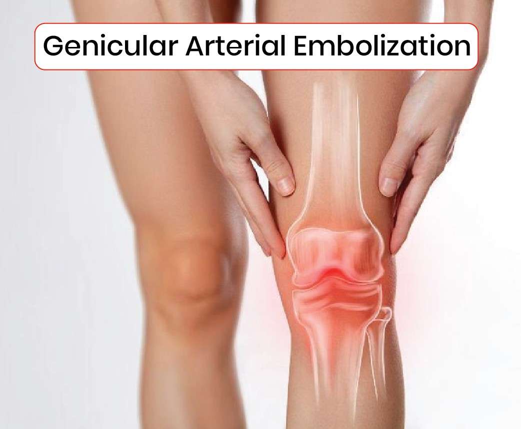 Genicular arterial embolization