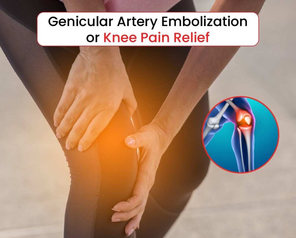 Genicular artery embolization or knee pain relief
