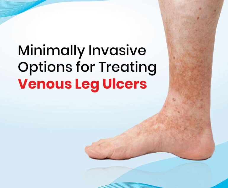 Minimally invasive options for treating venous leg ulcers