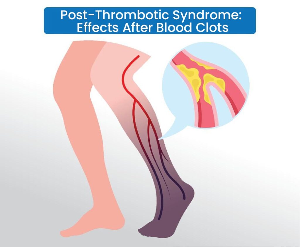 Post thrombotic syndrome effects after blood clots