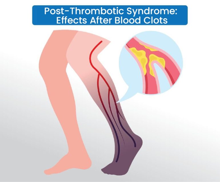Post thrombotic syndrome effects after blood clots