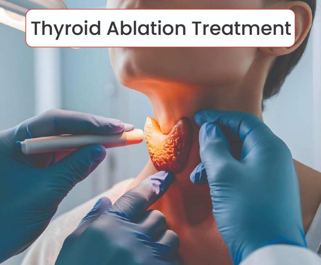 Thyroid Ablation Treatment