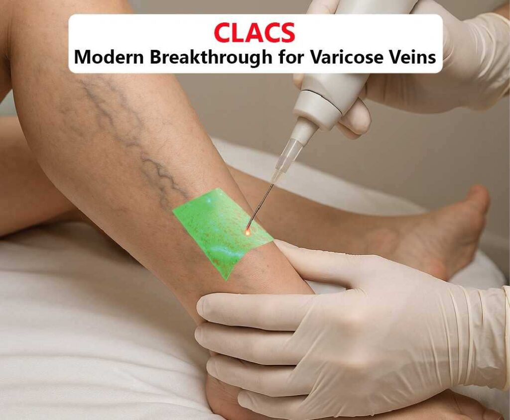 clacs modern breakthrough for varicose veins