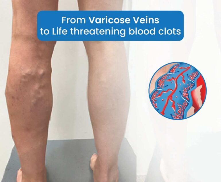 from varicose veins life threatening blood cloths