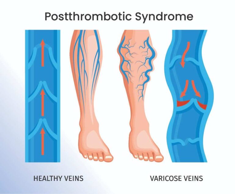 post thrombotic syndrome