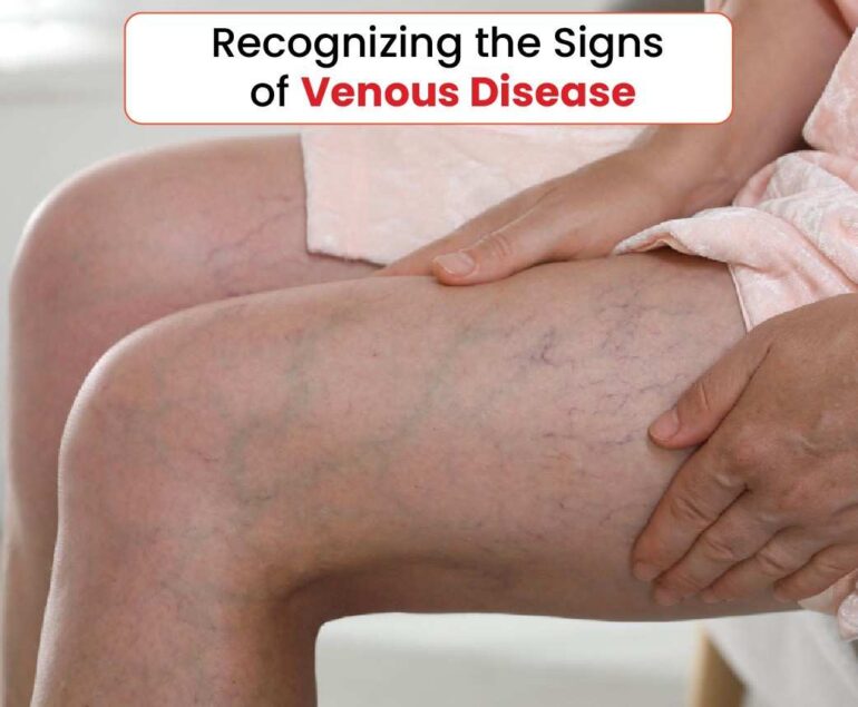 recognizing the signs of venous disease