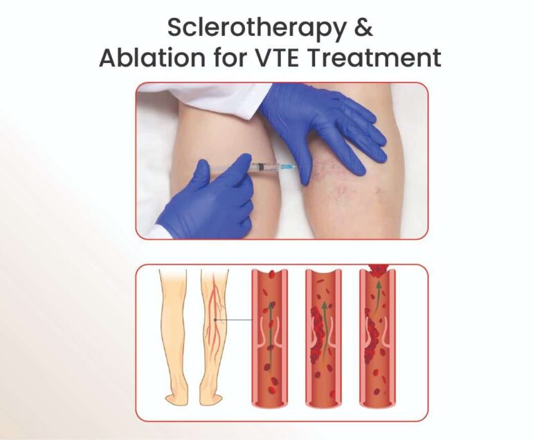 sclerotherapy ablation for vte treatment