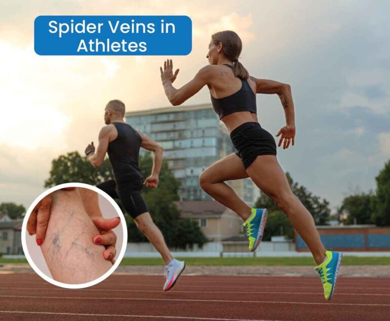 spider veins in athletes