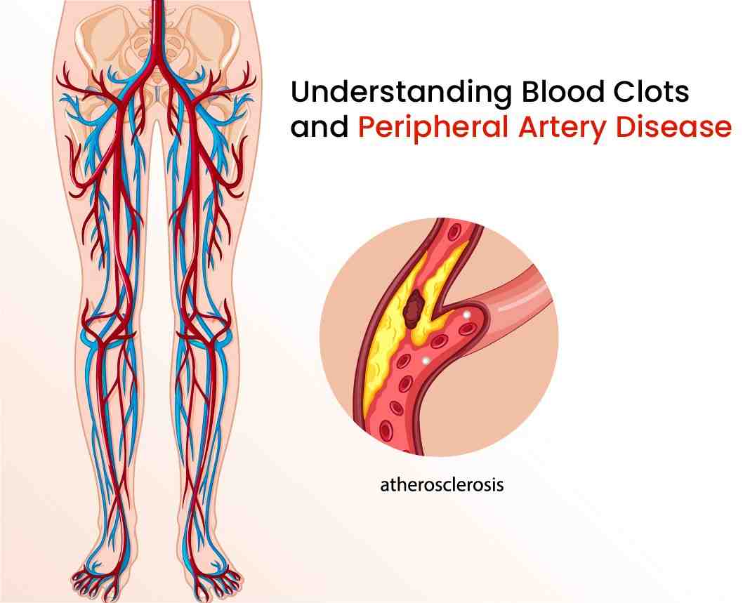 understanding blood clots and peripheral artery disease
