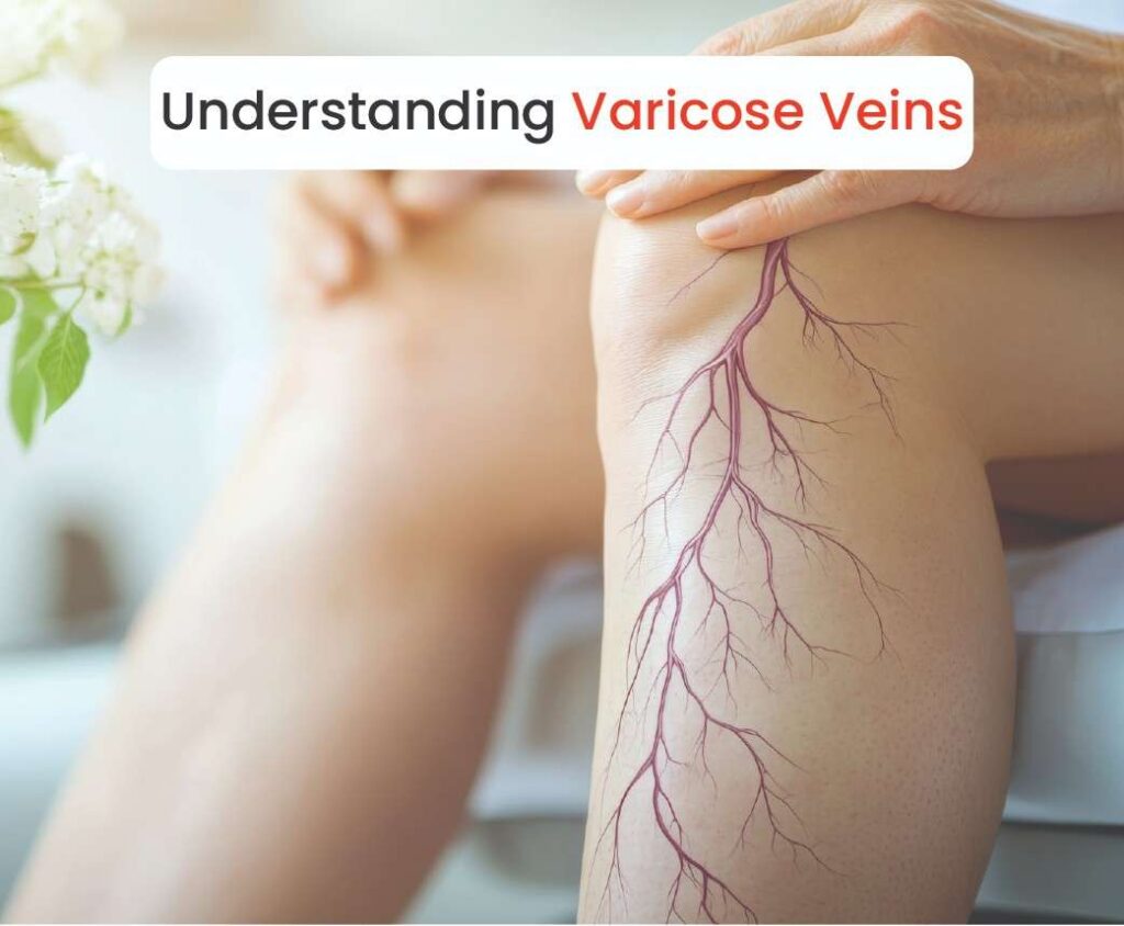 understanding varicose veins