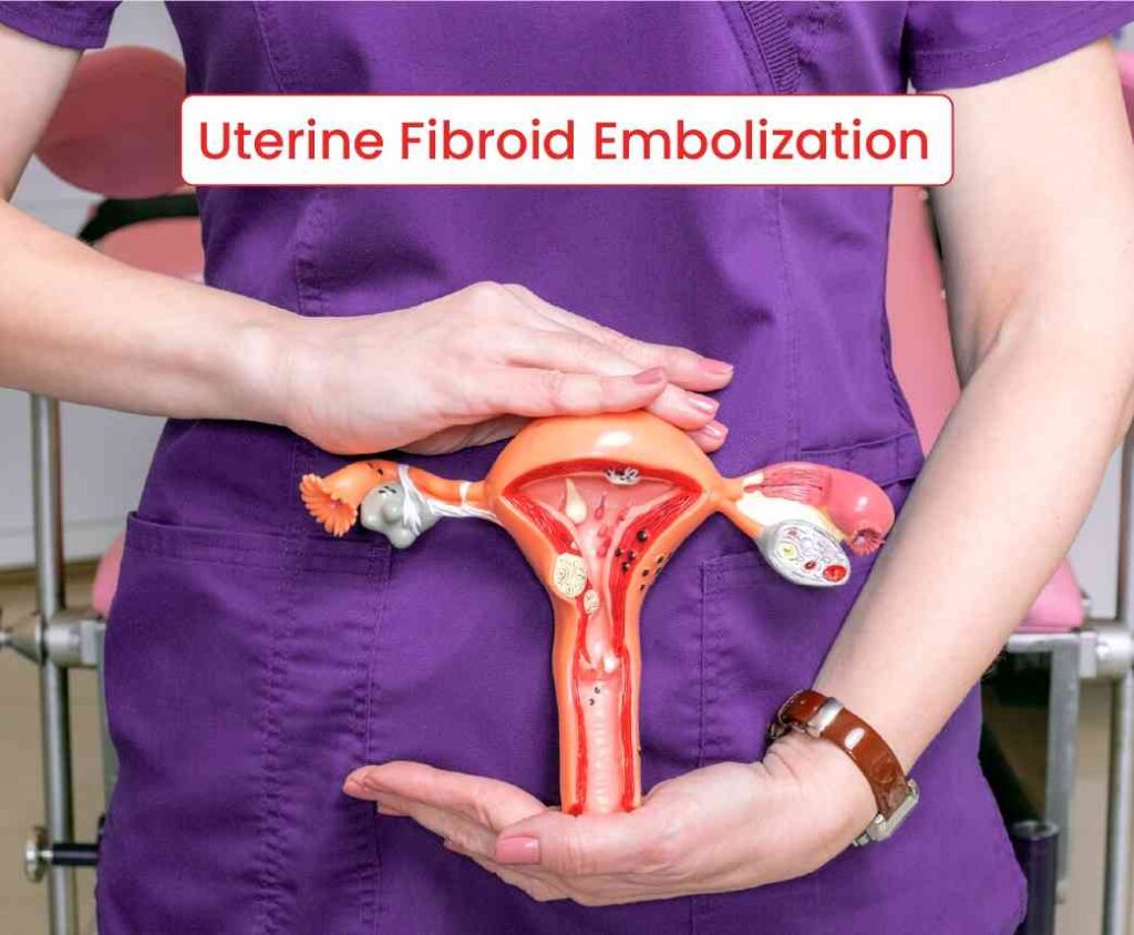 uterine fibroid embolization