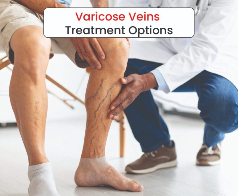 varicose veins treatment options img