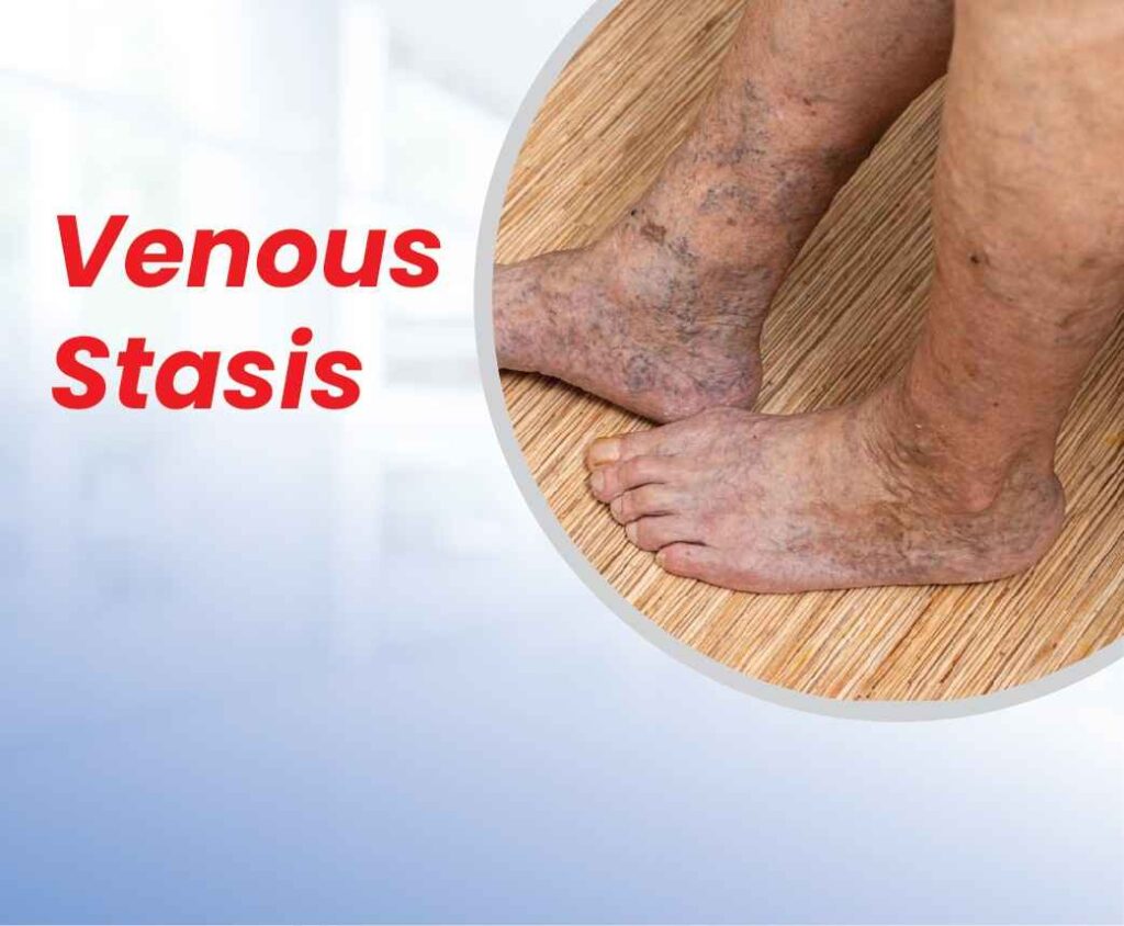 venous stasis