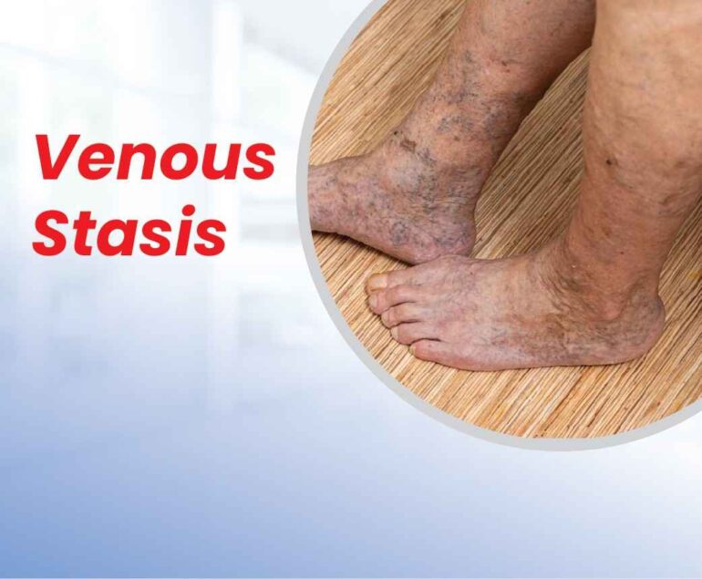venous stasis