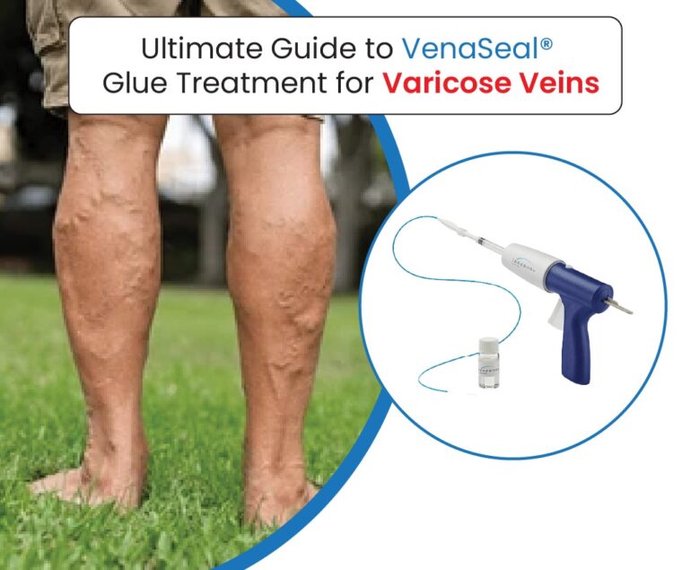 ultimate guide to Venaseal glue treatment for varicose veins
