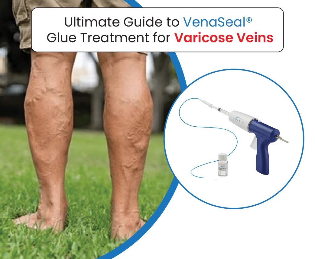 ultimate guide to Venaseal glue treatment for varicose veins