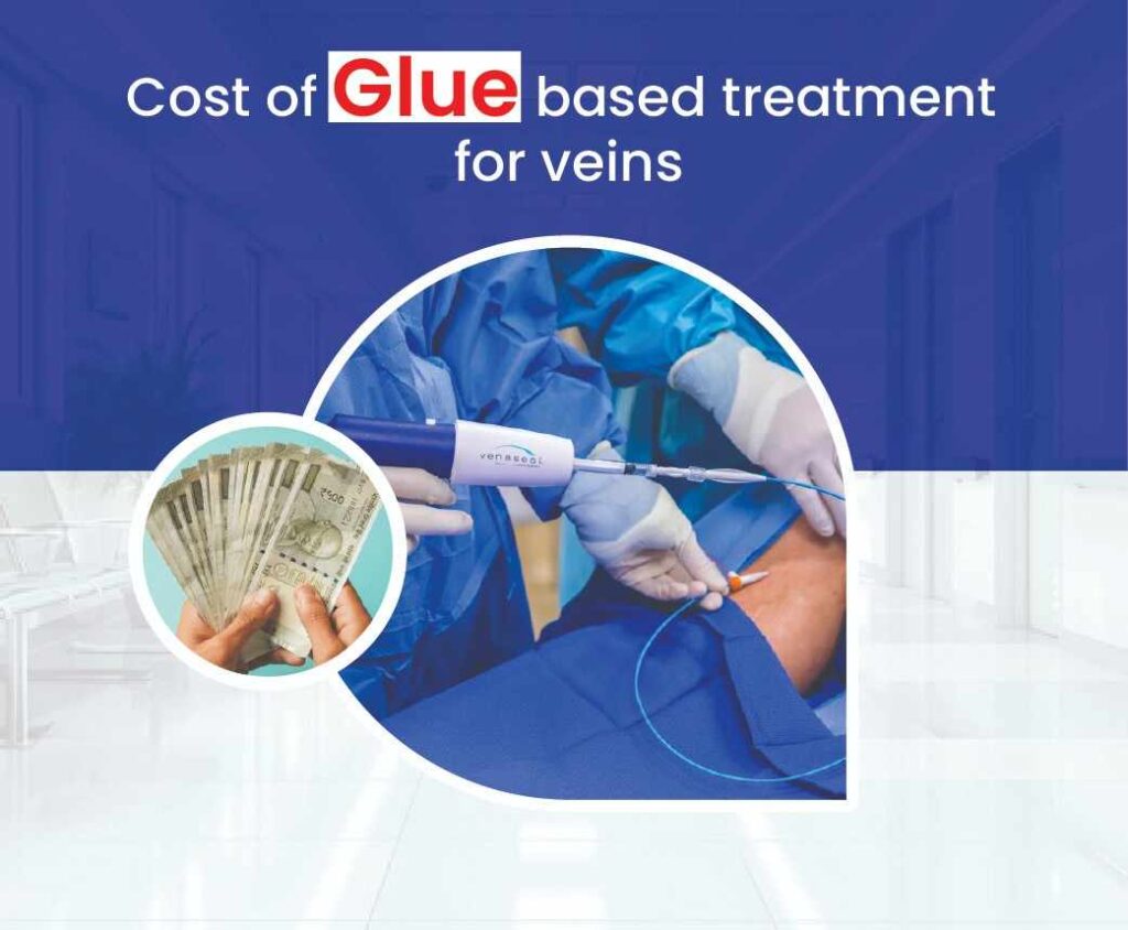cost of Glue based treatment for veins