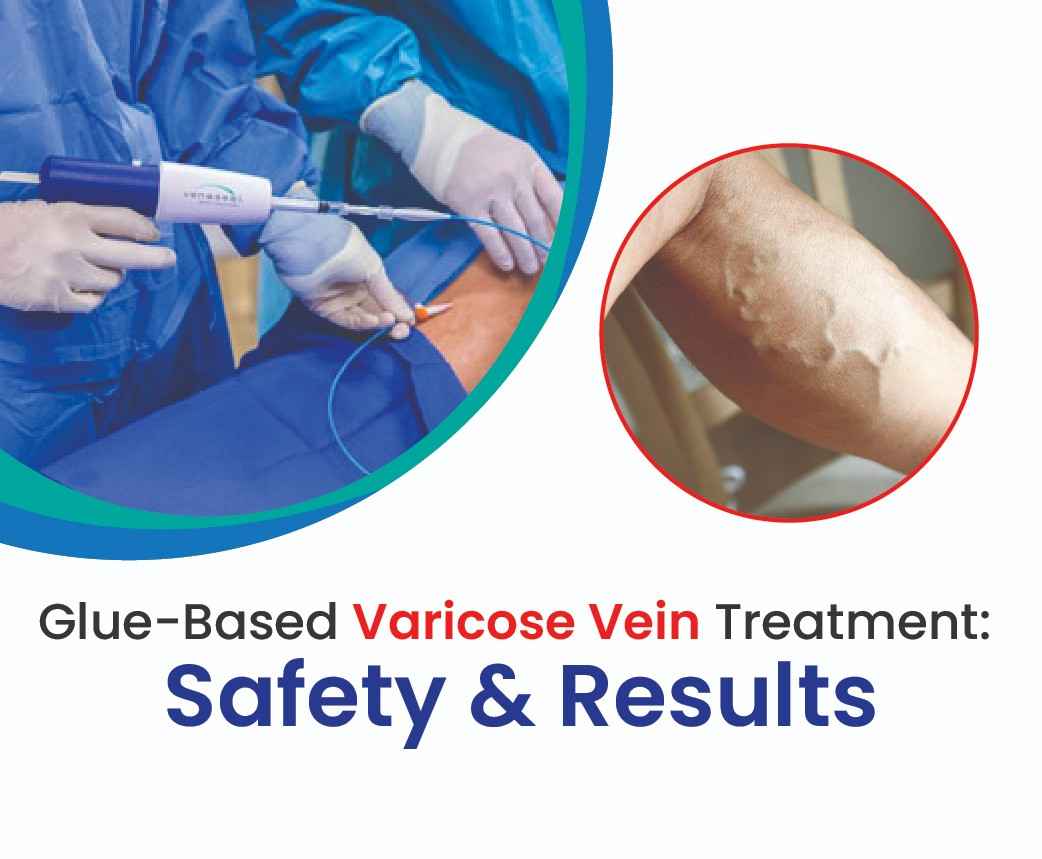 glue based varicose veins treatment
