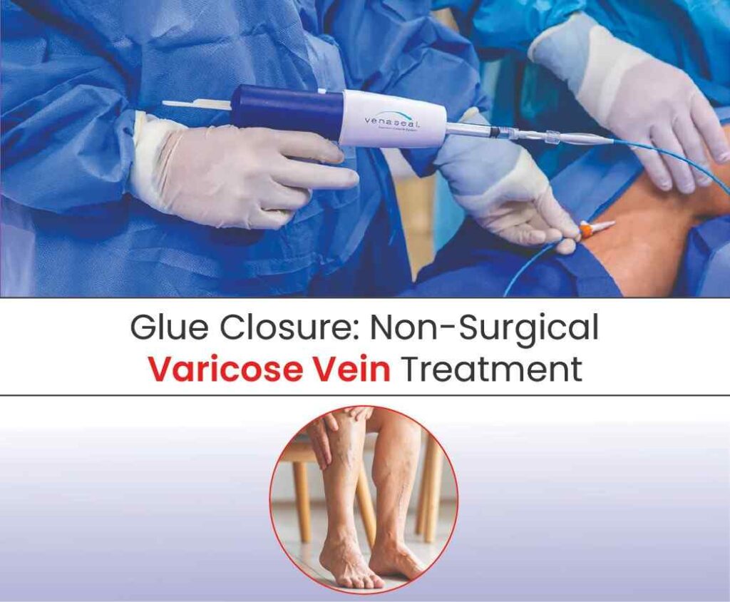 glue closure Non surgical varicose vein treatment