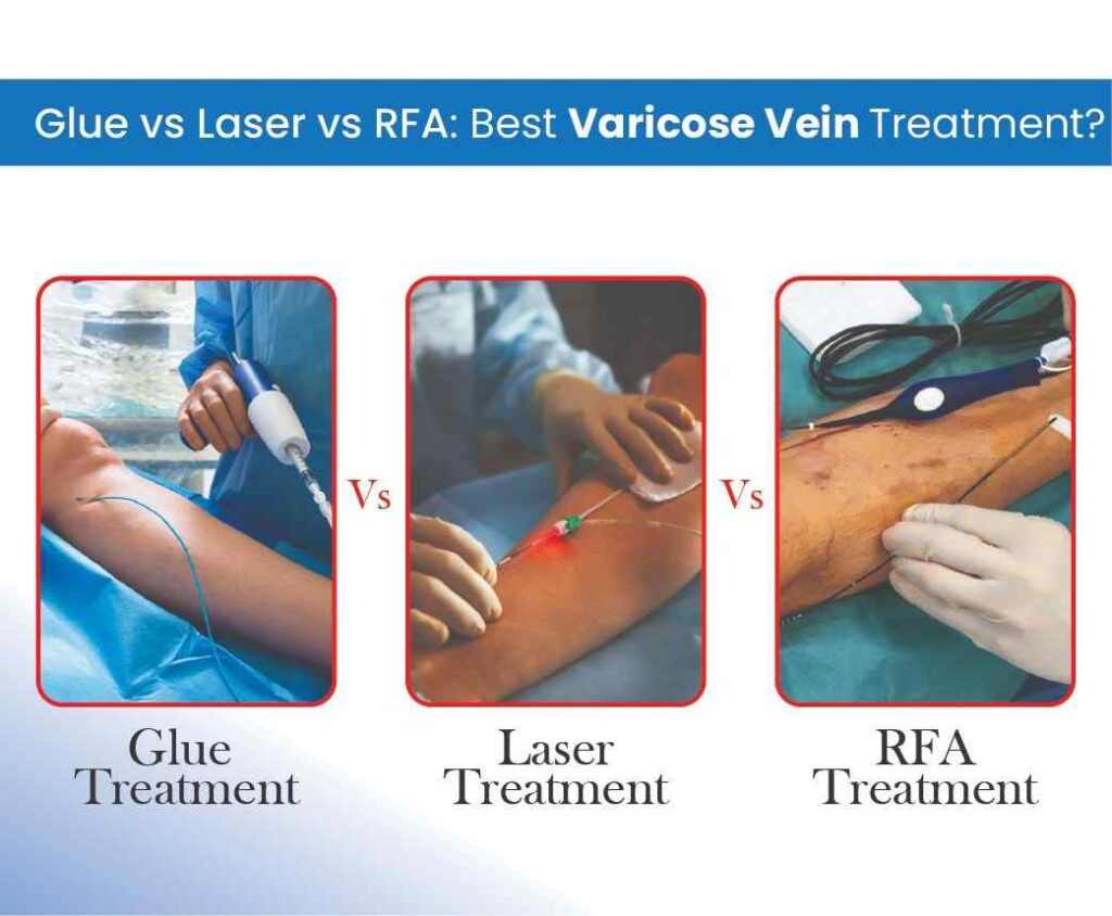 gluevslaservsrfa treatment