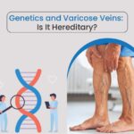 Genetics and Varicose veins