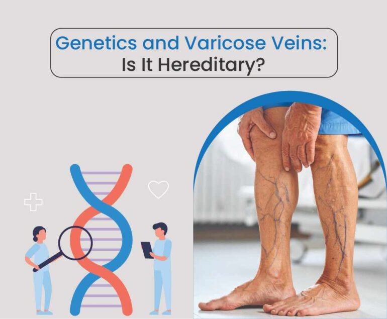 Genetics and Varicose veins
