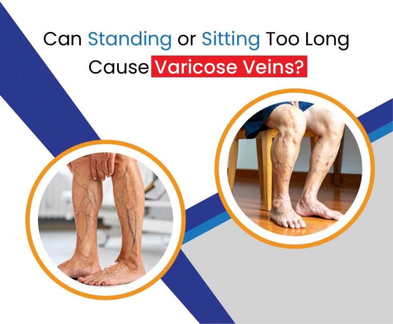 can standing or sitting too long cause varicose veins