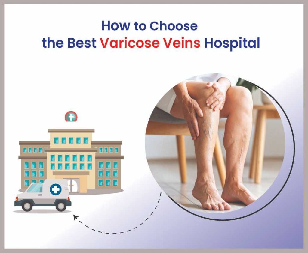 how to choose the best varicose veins hospital